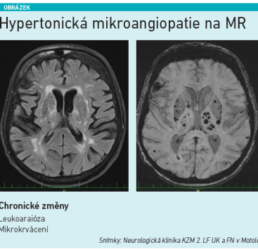 Hypertonická mikroangiopatie na MR