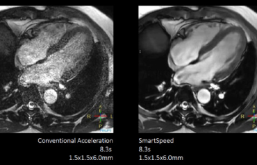 Inovativní akcelerační techniky Philips Compressed SENSE a Philips SmartSpeed umožňují zkrácení jednotlivých MR sekvencí i kompletního vyšetření při zachování kvality obrazu. Snimky archiv Philips