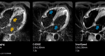 Inovativní akcelerační techniky Philips Compressed SENSE a Philips SmartSpeed umožňují zkrácení jednotlivých MR sekvencí i kompletního vyšetření při zachování kvality obrazu. Snimky archiv Philips