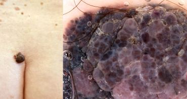 Klinický a dermatoskopický obraz melanomu v gluteální krajině Foto archiv prof. Arenbergerové