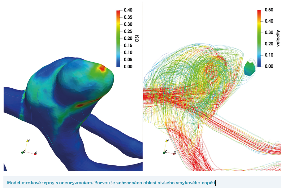 Model mozkové tepny s aneuryzmatem. Barvou je znázorněna oblast nízkého smykového napětí Model mozkové tepny s aneuryzmatem. Barvou je znázorněna oblast nízkého smykového napětí