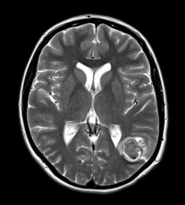 Obr. 1 Axiální T2WI MR mozku odhalila hypointenzní lézi s hypointenzním hemosiderinovým prstencem s malým perifokálním edémem. Na SWI nebyla suspekce na další kavernomy, nebyla identifikována žádná DVA