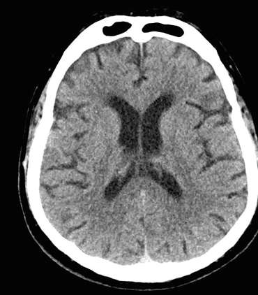 Obr. 1 CT mozku – normální nález