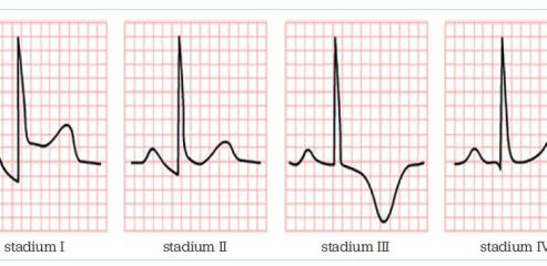 Obr. 1 EKG změny u akutní perikarditis – vývoj změn PR a ST úseků ve čtyřech stadiích. Zdroj: Gibson CM, Najafi H. Pericarditis electrocardiogram – wikidoc. https://en.ecgpedia.org/wiki/Main