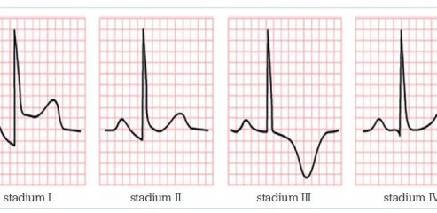 Obr. 1 EKG změny u akutní perikarditis – vývoj změn PR a ST úseků ve čtyřech stadiích. Zdroj: Gibson CM, Najafi H. Pericarditis electrocardiogram – wikidoc. https://en.ecgpedia.org/wiki/Main