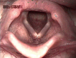 Obr. 1 Normální laryngoskopický nález.