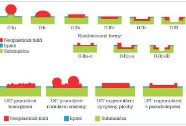 Obr. 1 Pařížská endoskopická klasifikace časných povrchových lézí postihujících sliznici nebo invazivně pronikajících do submukózy