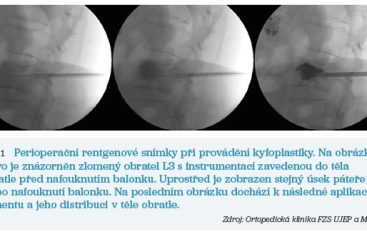 Obr. 1 Perioperační rentgenové snímky při provádění kyfoplastiky