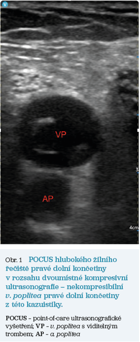 Obr. 1 POCUS hlubokého žilního řečiště pravé dolní končetiny v rozsahu dvoumístné kompresivní ultrasonografie – nekompresibilní v. poplitea pravé dolní končetiny z této kazuistiky.
