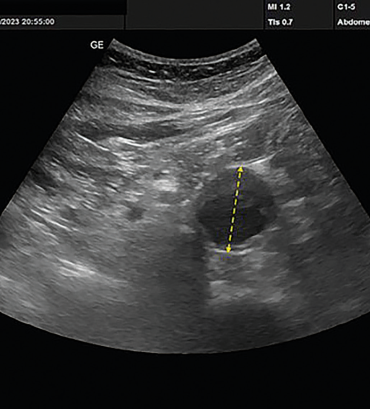 Obr. 1 POCUS nález dilatace břišní aorty (zevní – zevní kontura cévy cca 35 mm) u pacienta z kazuistiky (trvání vyšetření 4 min) POCUS – Point‑of‑Care ultrasonografie