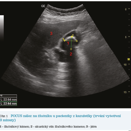 Obr. 1 POCUS nález na žlučníku u pacientky z kazuistiky