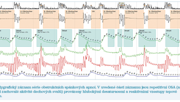 Obr. 1 Polygrafický záznam série obstrukčních spánkových apnoí.