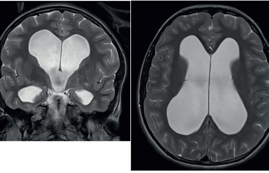 Obr. 1 T2 vážený obraz MR v axiální a koronární rovině. Viditelná výrazná dilatace komorového systému. MR – magnetická rezonance