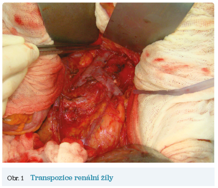Obr. 1 Transpozice renální žíly Obr. 1 Transpozice renální žíly