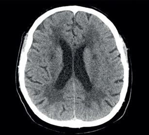 Obr. 1 Vyšetření pomocí CT mozku: hypodenzní změny bílé hmoty subkortikálně a paraventrikulárně oboustranně, drobné lakuny v bazálních gangliích. CT – výpočetní tomografie