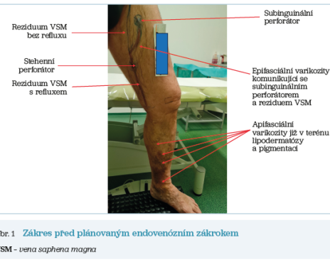 Obr. 1 Zákres před plánovaným endovenózním zákrokem