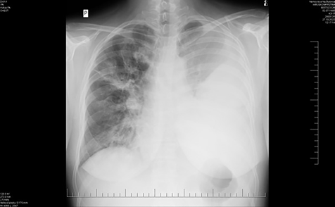 Obr. 1 Zánětlivý infiltrát v levé polovině hrudníku s fluidothoraxem, menší rozsah nálezu vpravo.