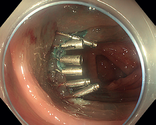 Obr. 15 Spodina po endoskopické slizniční resekci uzavřená klipy.