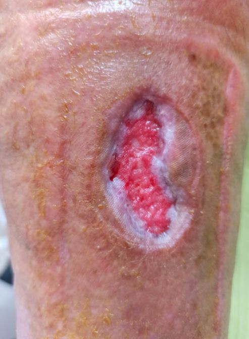 obr 1b 56. den obr 1b 56. den