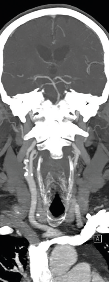 Obr. 2 CT angiografie extrakraniálních a intrakraniálních tepen s významnou kalcifikovanou stenózou pravé ACI ACI – arteria carotis interna