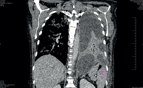Obr. 2 CT hrudníku – fluidothorax vlevo, septace výpotků v rozsahu celé plíce. CT – výpočetní tomografie