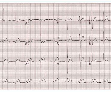 Obr. 2 EKG křivka u akutní perikarditis – repolarizační změny PR a ST úseků. Zdroj: Bray J, Meghji S. Pericarditis – ECG interpretation. https://xerte.cardiff.ac.uk