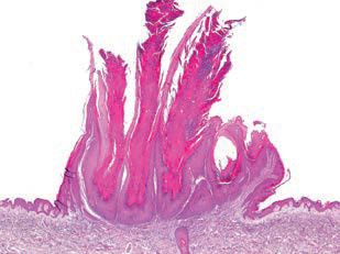 Obr. 2 Histopatologický obraz verruca vulgaris.
