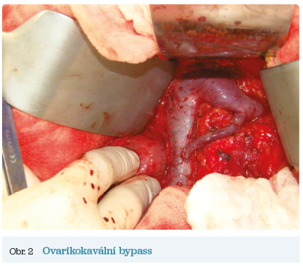 Obr. 2 Ovarikokavální bypass Obr. 2 Ovarikokavální bypass