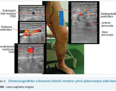 Obr. 2 Ultrasonografické zobrazení žilních struktur před plánovaným zákrokem