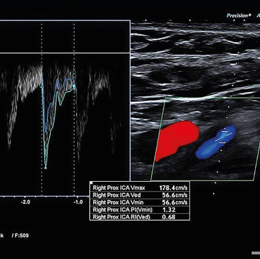 Obr. 3 Duplexní sonografie s obrazem symptomatické stenózy pravé ACI 80–85 % ACI – arteria carotis interna