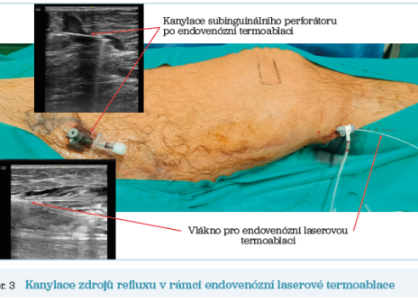 Obr. 3 Kanylace zdrojů refluxu v rámci endovenózní laserové termoablace