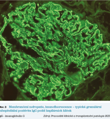 Obr. 3 Membranózní nefropatie, imunofluorescence