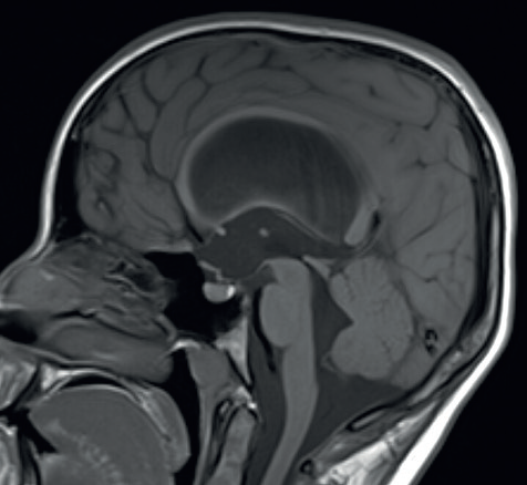 Obr. 3 T1 vážená sekvence MR mozku. Patrný bowing III. komory – vyboulení dna komory a jejích výběžků. MR – magnetická rezonance