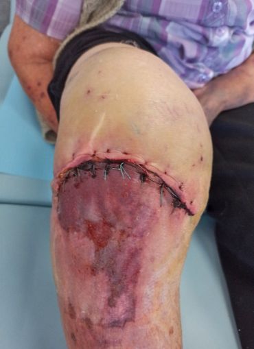 obr 3b 10. den po&nbsp;úrazu