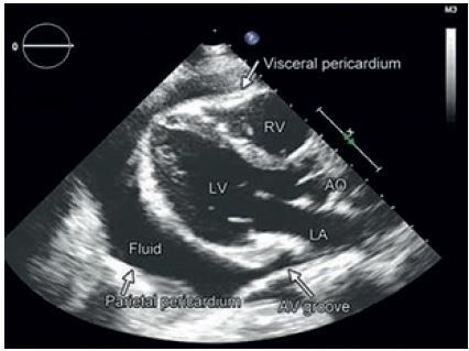 Obr. 4 Echokardiografické zobrazení perikarditis s rozsáhlým výpotkem – parasternální pohled. 