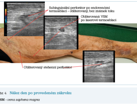 Obr. 4 Nález den po provedeném zákroku