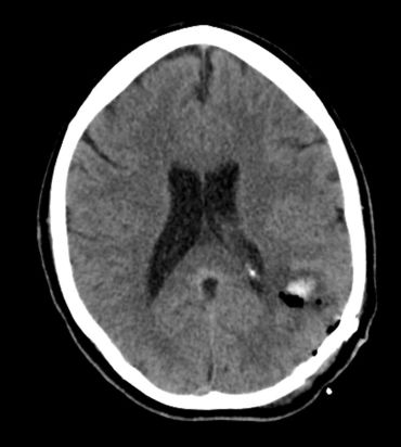 Obr. 4 Pooperační axiální CT vyšetření mozku ukazuje malý reziduální intracerebrální hematom, jinak přiměřený pooperační nález