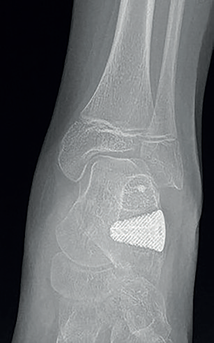 Obr. 6 RTG snímek pacienta po operaci dle Gricea s užitím 3D implantátu.