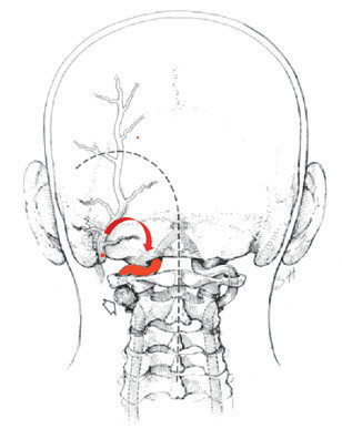 Obr. 6 Schéma bypassu – okcipitální arterie vlevo z povodí karotidy bude po anastomóze augmentovat tok ve vertebrální arterii vlevo, a tím v celém vertebrobazilárním povodí.
