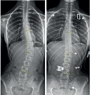 Obr. 6 Snímky čtrnáctileté dívky s levostrannou thorakolumbální skoliózou. 