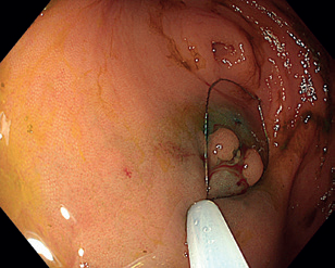 Obr. 7 Nakládání polypektomické kličky na lézi po submukózní injekci poblíž orificia appendixu.