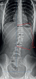 Obr. 1 Thorakolumbální skolióza Lenke typ 5 (Th11 – 23 sin. – L3), CSVL C – křivka tedy vykazuje abnormalitu ve frontální rovnováze. KO = koncový obratel; VO = vrcholový obratel. Horizontální linie procházející stříškami pánevních acetabul vylučuje asymetrii výšek kyčelních kloubů. Zdroj: Ortopedická klinika FZS UJEP a MN UL.