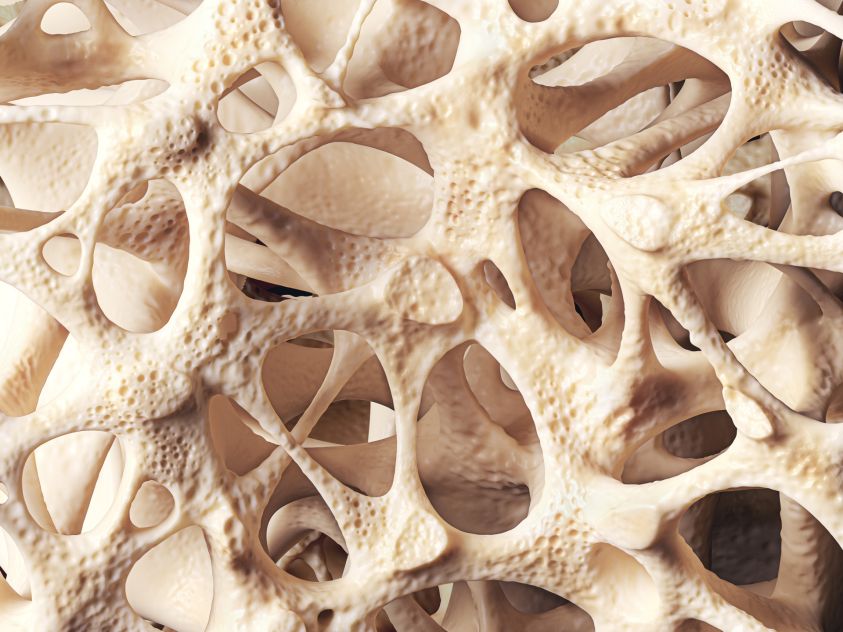 Bone structure with osteoporosis