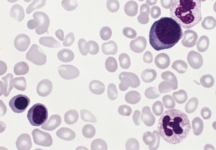 Polycythemia_vera,_blood_smear