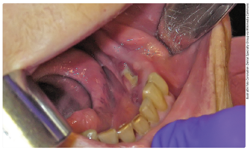 Ilustrační foto Coronation Dental Specialty Group via Wikimedia Commons