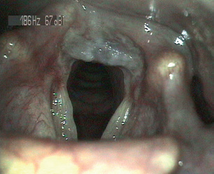 Obr. 2 Nález charakteristický pro EERCH – nápadné poškození sliznice hrtanu – edém v arytenoidní krajině, hustý hlen, obliterace ventriculus laryngis. EERCH – mimojícnová refluxní choroba jícnu (extraezofageální refluxní choroba)