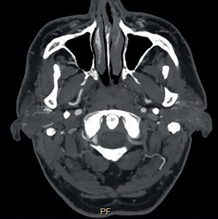 Obr. 4 Retrográdní tok v levé AV dosahoval až do horizontálního extrakraniálního úseku vertebrální arterie V3 vlevo v oblasti oblouku prvního krčního obratle C1 (šipka). AV – arteria vertebralis