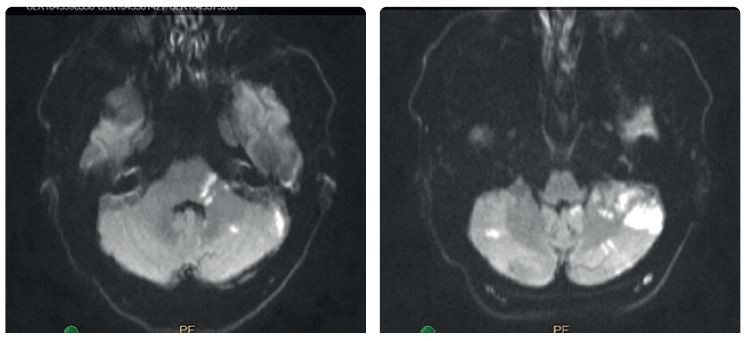 Obr. 1 MR DW zobrazila čerstvé ischemické změny v dolní části levé mozečkové hemisféry v teritoriu PICA (arteria cerebelli inferior posterior) vlevo a dále v bazi levého brachium pontis. Drobné změny jsou přítomny i v teritoriu horní mozečkové tepny vlevo a drobný okrsek restrikce se nachází v dolním okraji pravé mozečkové hemisféry v teritoriu PICA vpravo. MR DW – magnetickorezonanční obraz s difuzním vážením (magnetic resonance diffusion‑weighted)