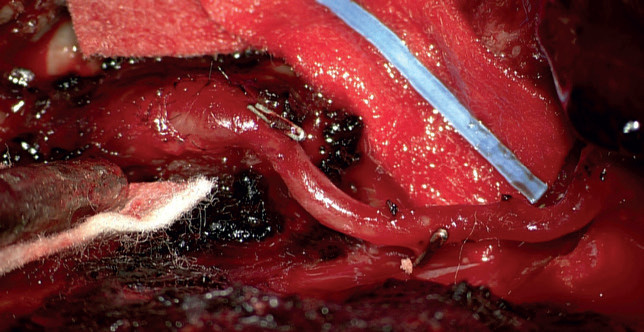 Obr. 7 Detail anastomózy OA‑V3 (okcipitální arterie na vertebrální arterii V3). Okcipitální arterie vlevo z povodí karotidy je našita mikrotechnikou vláknem 9/0 „end to side“ na extrakraniální vertebrální arterii těsně před vstupem do intrakraniálního prostoru, k bypassu nebylo třeba provést kraniotomii.
