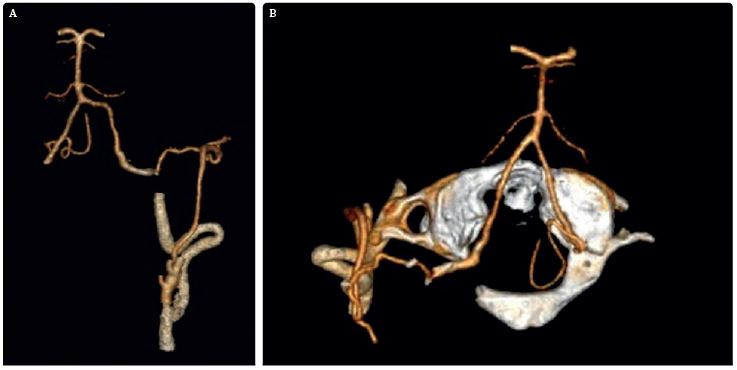 Obr. 8A–B Pooperační CTA dobře patentního bypassu. CTA ukazuje průtok z povodí a. carotis externa cestou a. occipitalis do levé a. vertebralis a celého vertebrobazilárního povodí (místo anastomózy označeno červeným kruhem). CTA – výpočetní tomografie – angiografie